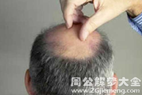 【梦见老公秃顶】