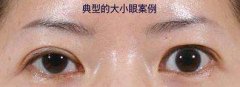 眼睛一大一小的面相好吗？