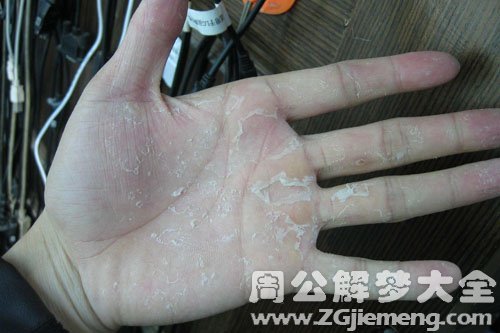 【梦见掉皮】